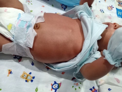 ลูก 19 Day มีอาการกินนมเยอะ และมีอาการท้องอืดค่ะ