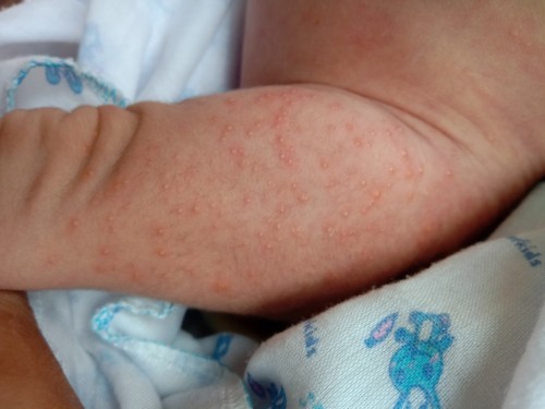 อยากทราบว่ามันเป็นตุ่มอะไรควรไปหาหมอมั้ยคะ