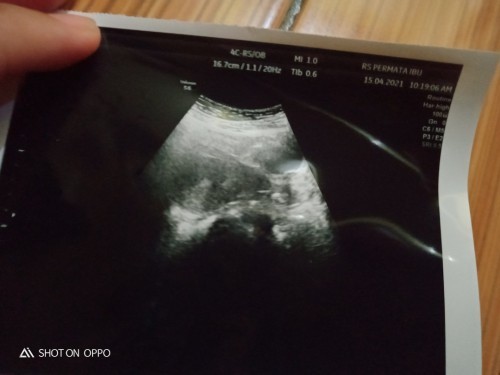Apakah bunda disini ada yg hmil 7minggu USG blm terlihat apa"