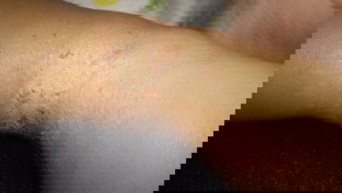 Kulit keeing kemerahan an gatal