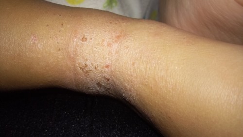 Kulit keeing kemerahan an gatal