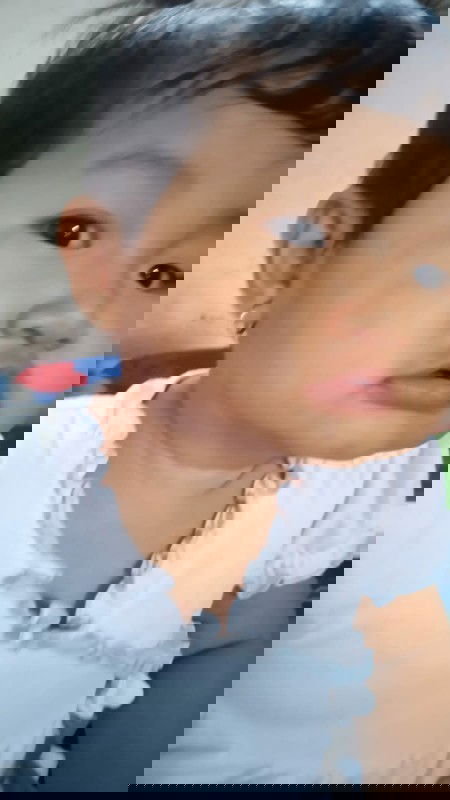 Bercak putih di pipi