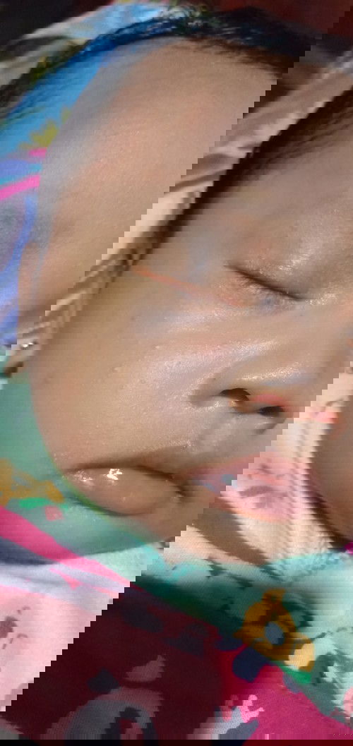 Beruntus dan kemerahan