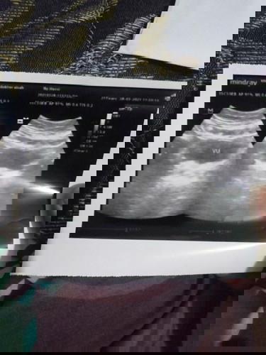 Bund aku udh tlat mens 3bulan tapi di tp msh negatif , usg kosng gni trs dipjet udh hamil ktnyaa ??