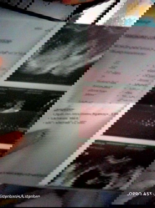 tanong ko po anu po ba ibig sabhin ng
Subcharionic bleed??