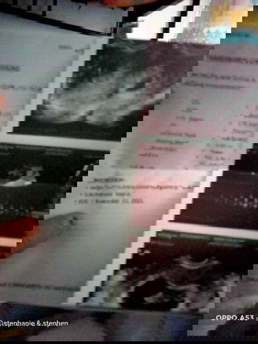 tanong ko po anu po ba ibig sabhin ng
Subcharionic bleed??