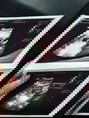 Heartbeat 7w5d