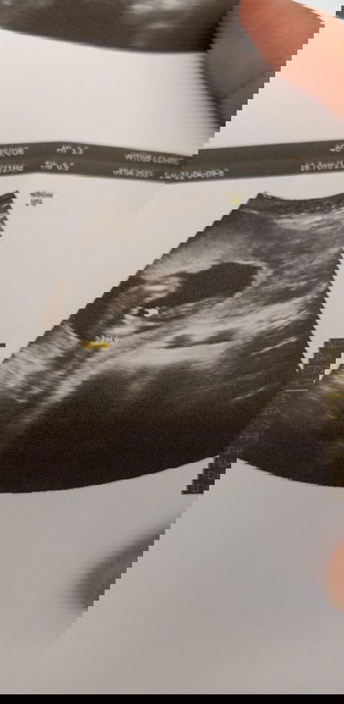 เห็นชัดมากเลย #กระจู๋ 
20w6dแล้ว บ้านไหนลูกชายบ้างค่ะ ทีมคลอดเดือนสิงหาคมจ้า😊😊