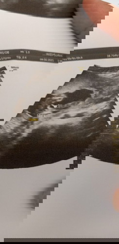 เห็นชัดมากเลย #กระจู๋
20w6dแล้ว บ้านไหนลูกชายบ้างค่ะ ทีมคลอดเดือนสิงหาคมจ้า😊😊