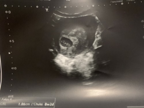 คุณแม่ท้องแรก