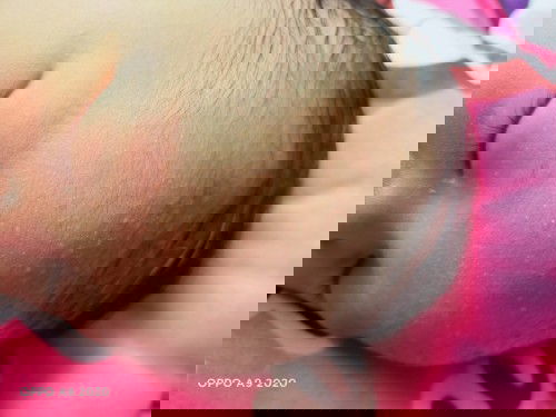 น้องอายุ8วันมีตุ่มใสๆขึ้นที่หน้าผากกับตุ่มแดงเล็กๆที่คอข้างหลัง