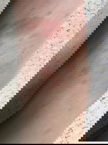 ใครเคยถูกยุงกัดแล้วมีผื่นขนาดนี้บ้าง