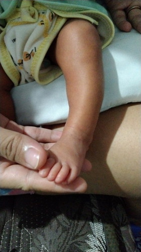 Kaki bayi bengkok