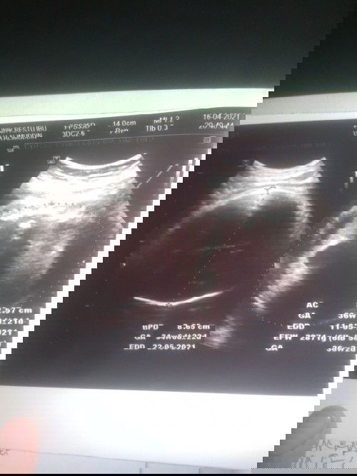 Bun kemarin aku habis usg kok beda ya perhitungan usg sma apk 
Apk 37 usg 36 dan hpl pun jadi mundur