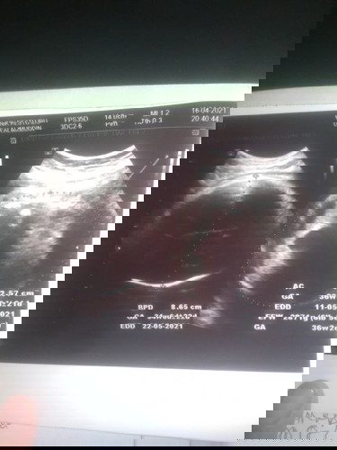 Bun kemarin aku habis usg kok beda ya perhitungan usg sma apk
Apk 37 usg 36 dan hpl pun jadi mundur