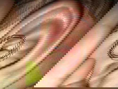 หลุมคล้ายหลุมสิว