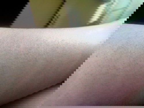 ขาเป็นผื่นแบบนี้จะเป็นไรไหมค่ะ
และคันมากค่ะ