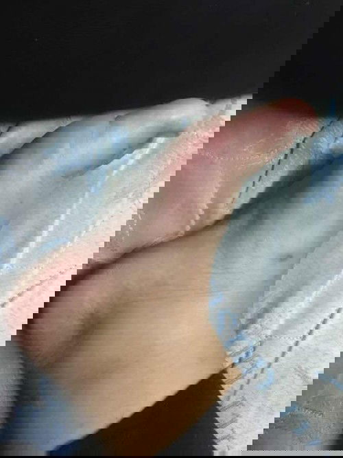 เท้าบวมมากก