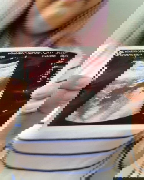 Non Invasive Prenatal Testing by GenePlanet