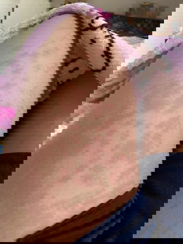 ผื่นหลังผ่าคลอดแบบบล็อคหลัง