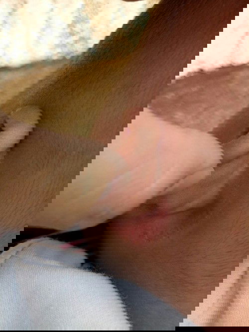 Ruam di lipatan telingan