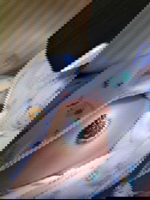 สะดือลูกชายแบบนี้ปกติไหมครับอายุ17วันครับ