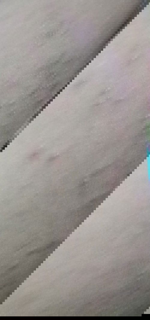 Gatal yang tidak kunjung sembuh,, bunda bunda ada yang mengalami seperti saya?