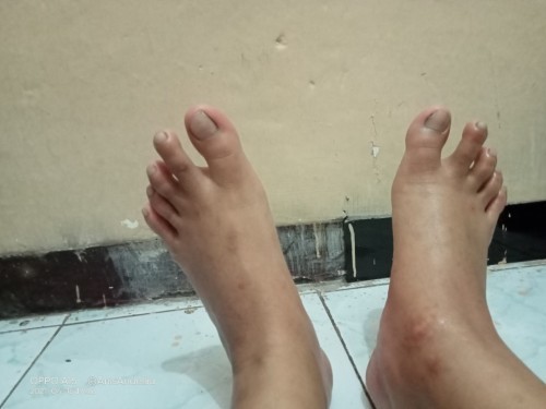 Kaki bengkak
