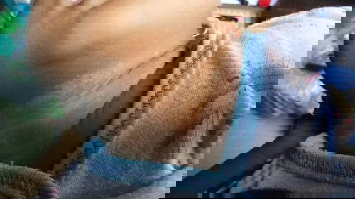 Ini knp ya? Gejala pertama kayak kringat buntet gitu merah2.Selang 3 hari merah jadi putih kyk gtu?