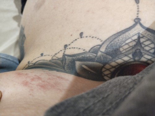 สอบถามหน่อยคะใครผื่นขึ้นที่ท้องมั่งไหมคะ