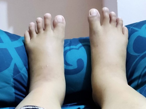 KAKI BENGKAK SETELAH MELAHIRKAN