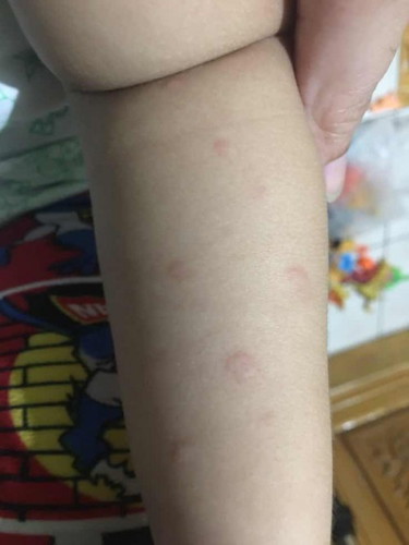 Hives on my 2 yr.old toddler