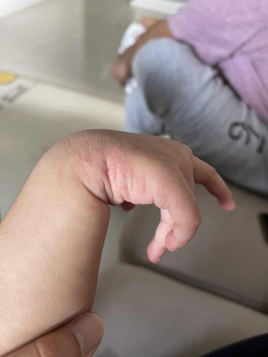 Itchy and marks on my 21 months baby