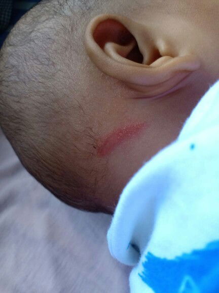 Merah pada belakang leher