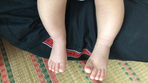 จำเป็นต้องดัดขาลูกไหมคะ