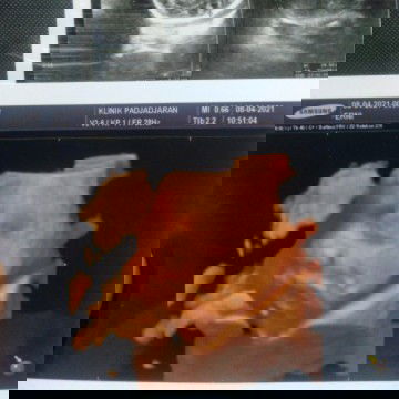 Hpl mei kepala udah dibawah tapi blm masuk panggul