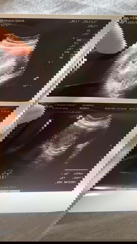 Hamil tapi pendarahan ?