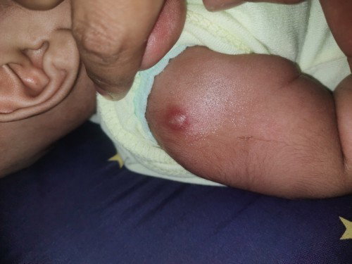 Benjolan atau ngajendul d tangan
