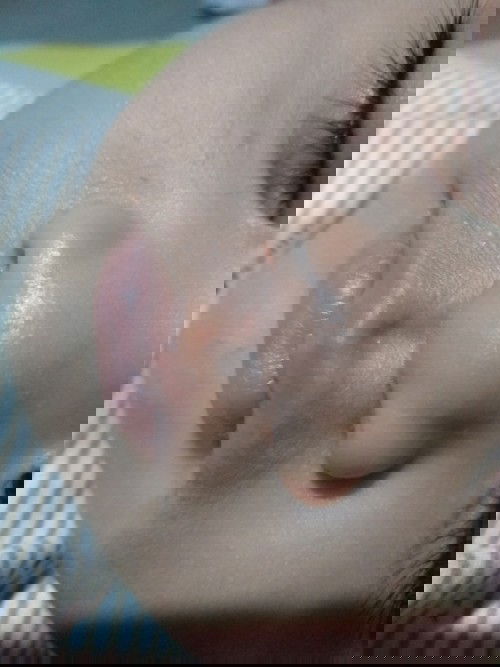 Menghilangkan bruntusan di muka bayi 6bulan