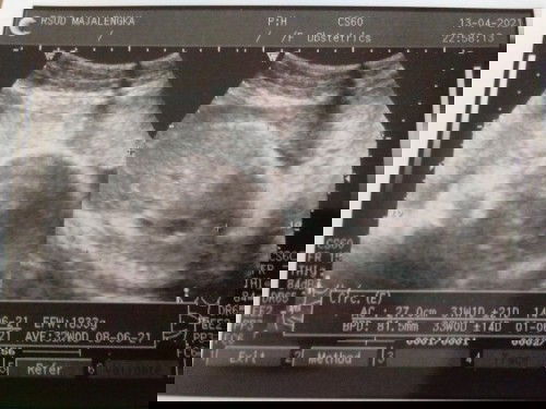 Pejuang lahiran normal