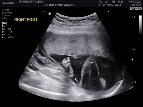19w3d
น้องโชว์เท้าให้แม่ดู 🧡👼🏻