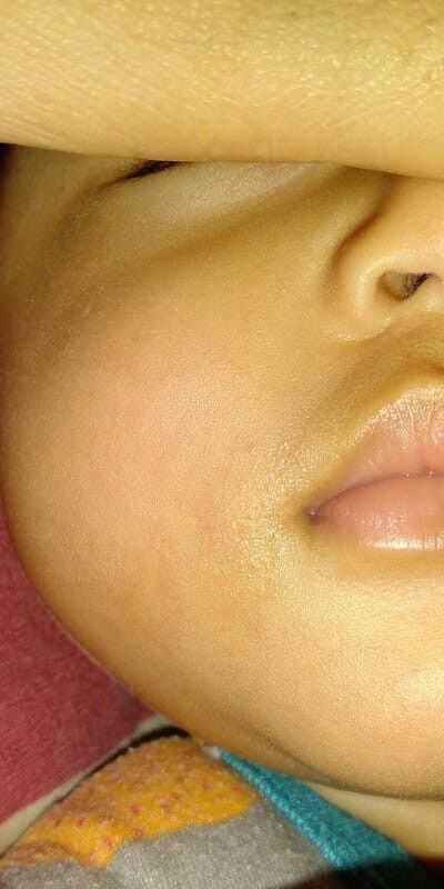 Bruntus² di ujung bibir dan di punggung