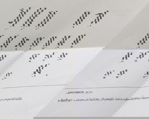 ตรวจคัดกรองดาวน์ซินโดรม