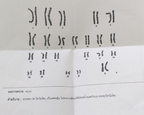 ตรวจคัดกรองดาวน์ซินโดรม