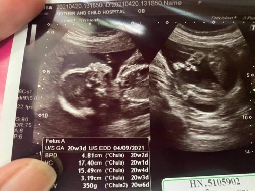ลองทายเล่นๆดูค่ะ แม่ๆคิดว่าเพศอะไรค่ะ🤰