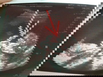 กำหนดคลอด 25/08/64 เดือนสิงหาคม