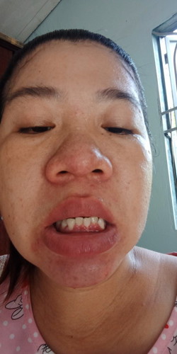 Cho e hoi e có bầu được 35tuần .mình bị sưng lợi nhiều và chảy máu có ảnh hưởng gì ko a