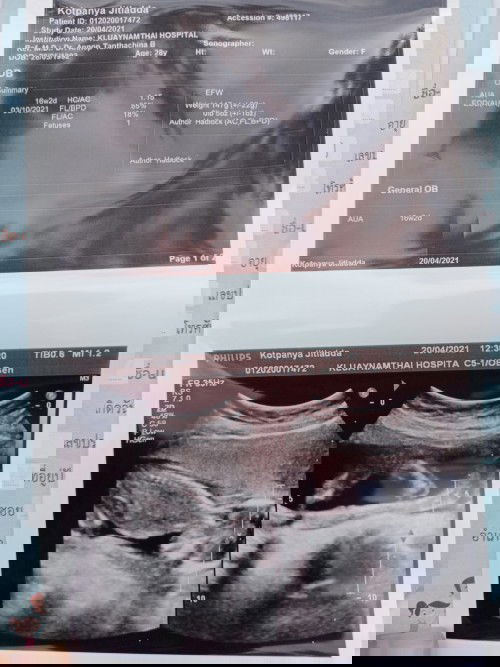 ลูกนอนคว่ำจะหายใจออกไหมค่ะ อายุครรภ์4เดือน