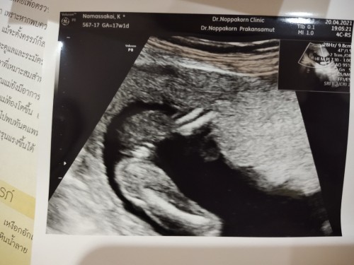 ทายเพศลูก🥰