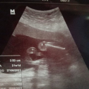 Hasil usg... Berharap dapat bayi kembar